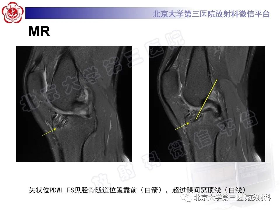 影像PPT - 【PPT】膝关节CYCLOPS病变-3