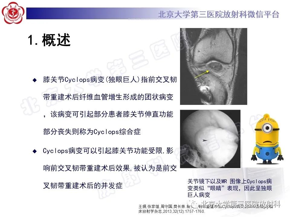 影像PPT - 【PPT】膝关节CYCLOPS病变-8