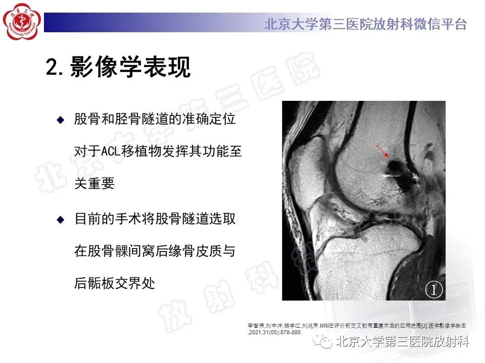影像PPT - 【PPT】膝关节CYCLOPS病变-13