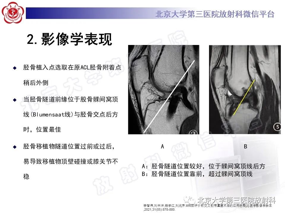 影像PPT - 【PPT】膝关节CYCLOPS病变-14
