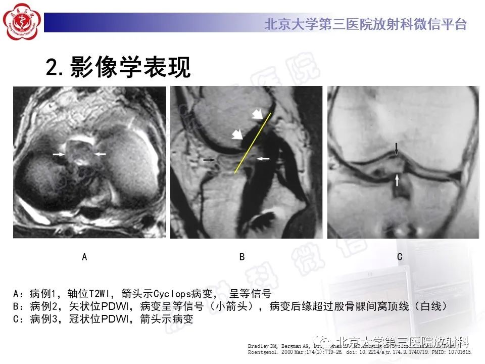 影像PPT - 【PPT】膝关节CYCLOPS病变-16