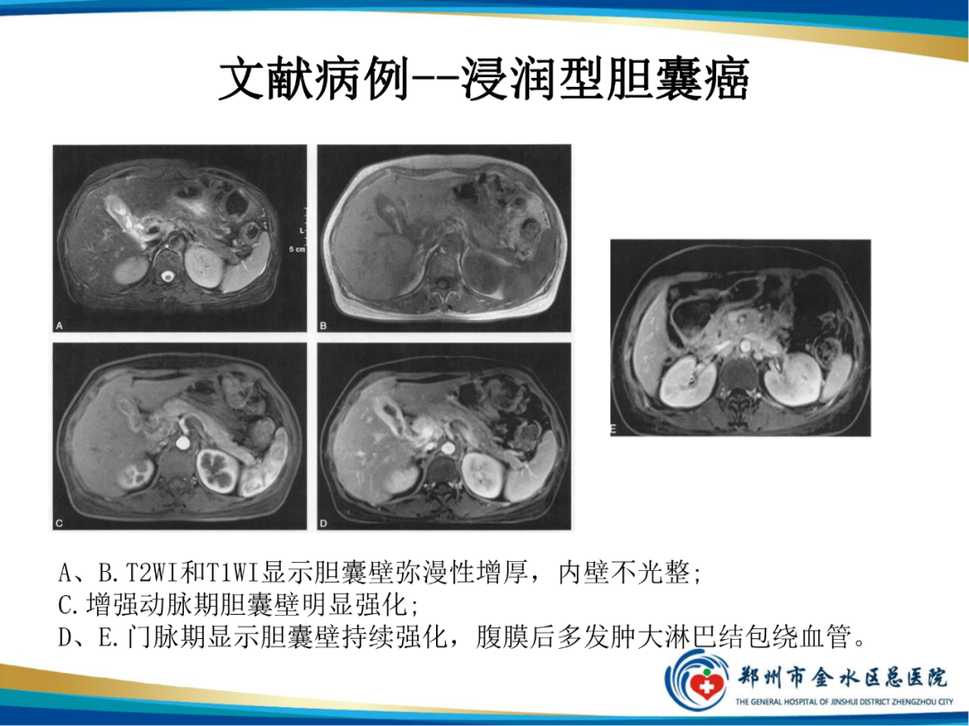 影像PPT - 【PPT】胆囊癌的影像诊断-10
