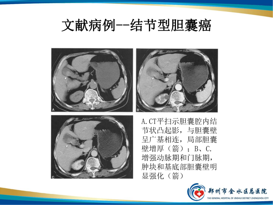 影像PPT - 【PPT】胆囊癌的影像诊断-11