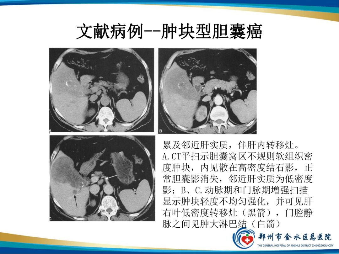 影像PPT - 【PPT】胆囊癌的影像诊断-12