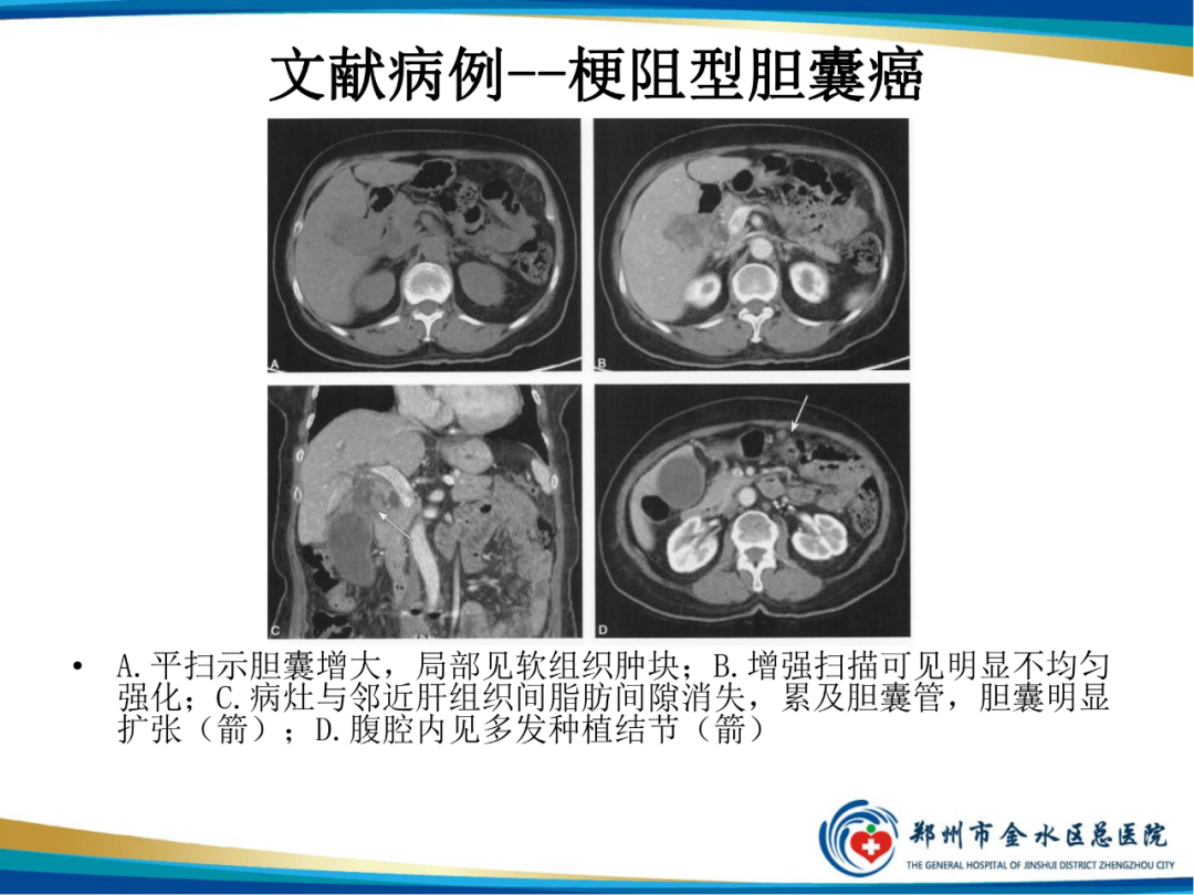 影像PPT - 【PPT】胆囊癌的影像诊断-13