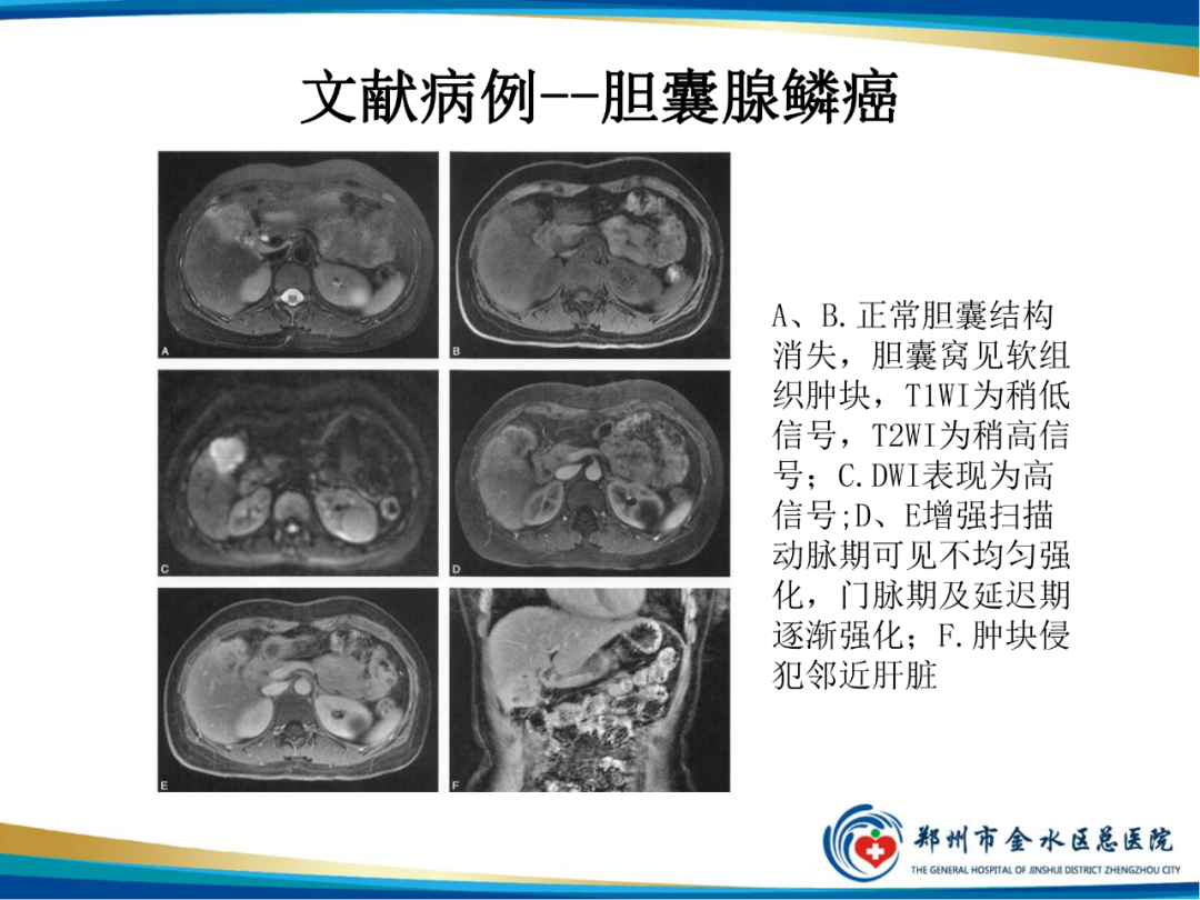 影像PPT - 【PPT】胆囊癌的影像诊断-15