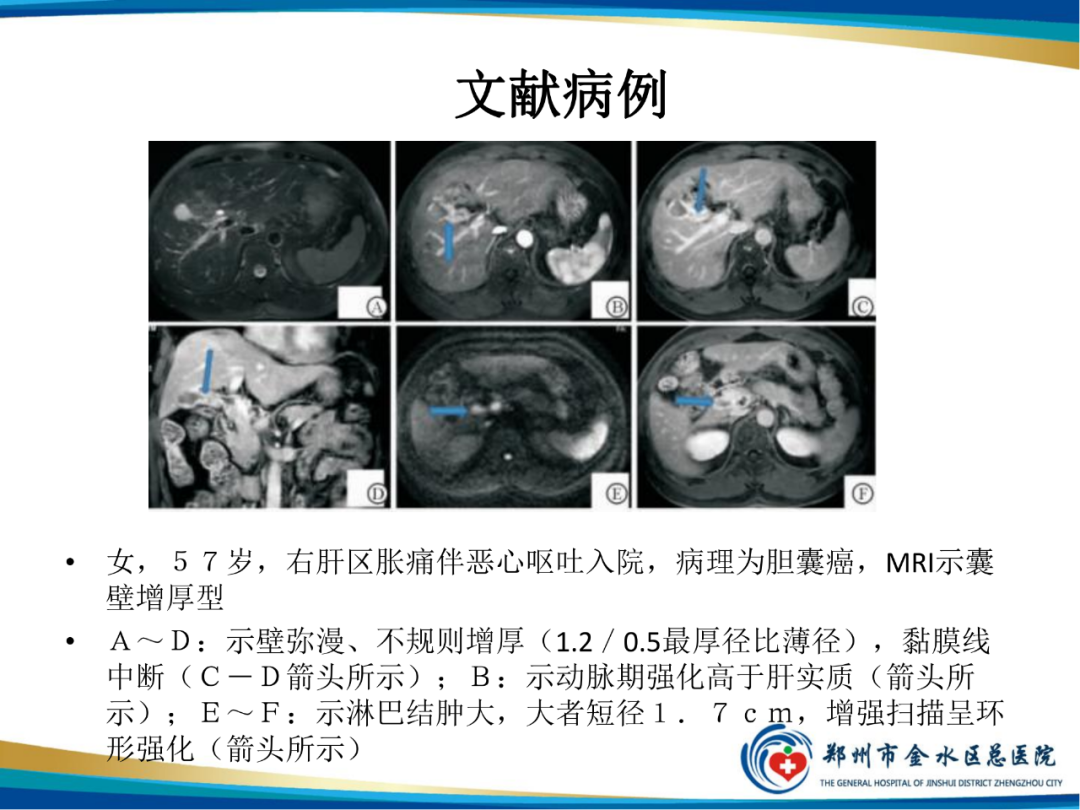 影像PPT - 【PPT】胆囊癌的影像诊断-16