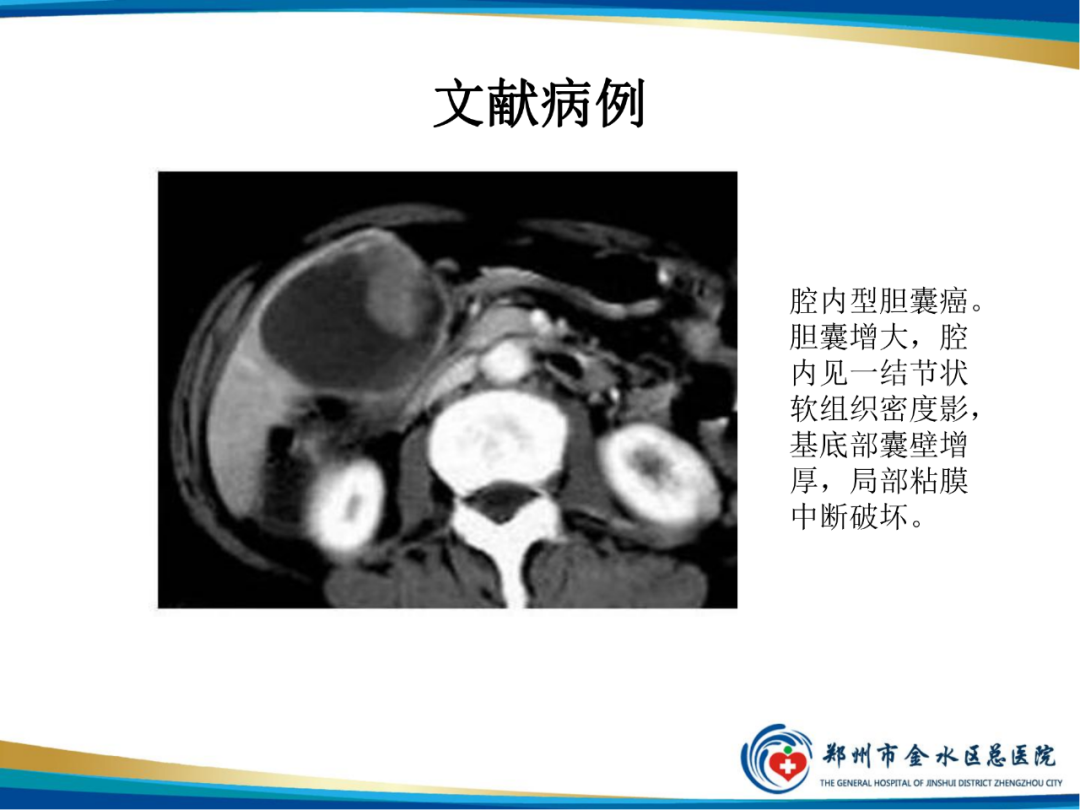 影像PPT - 【PPT】胆囊癌的影像诊断-17