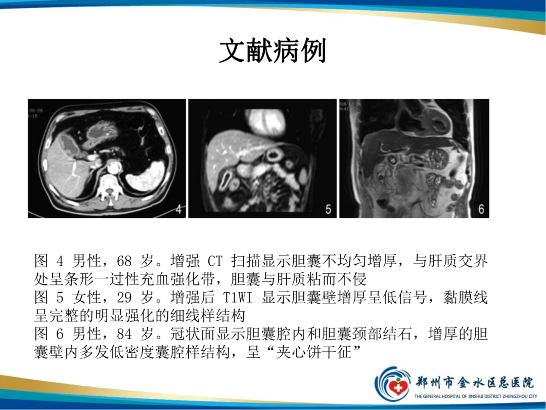 影像PPT - 【PPT】胆囊癌的影像诊断-20