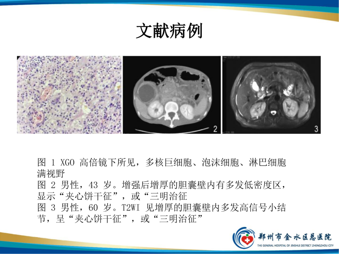 影像PPT - 【PPT】胆囊癌的影像诊断-19