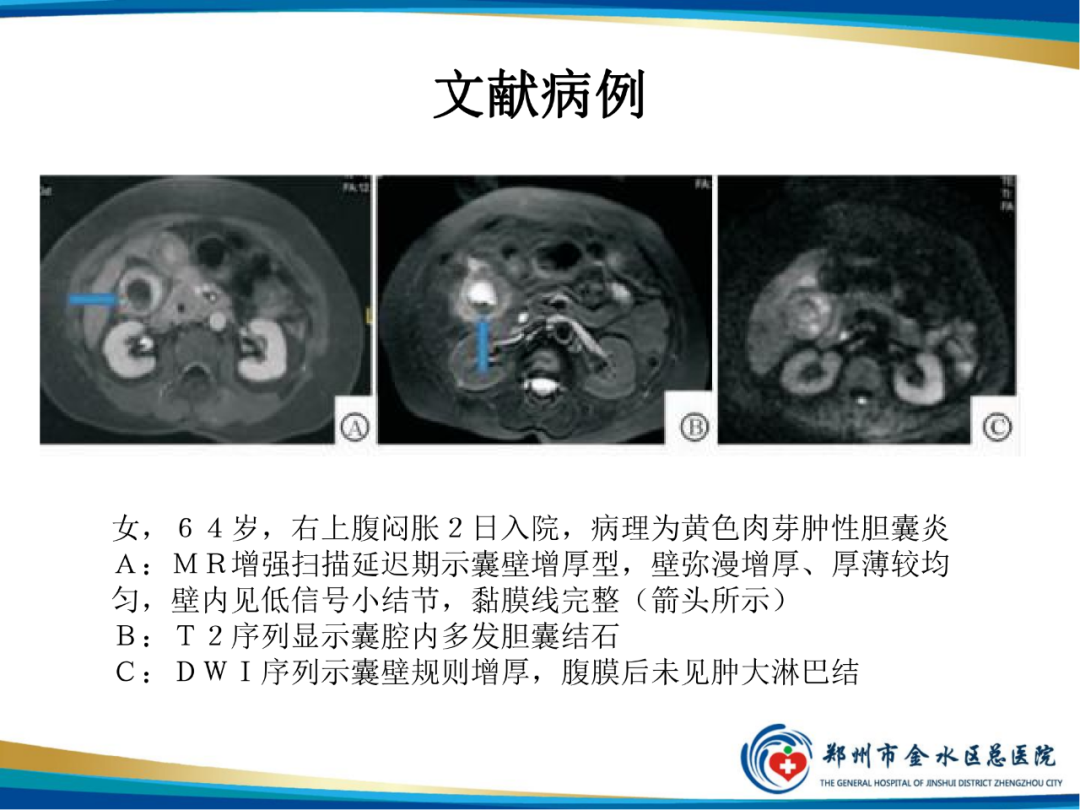 影像PPT - 【PPT】胆囊癌的影像诊断-21