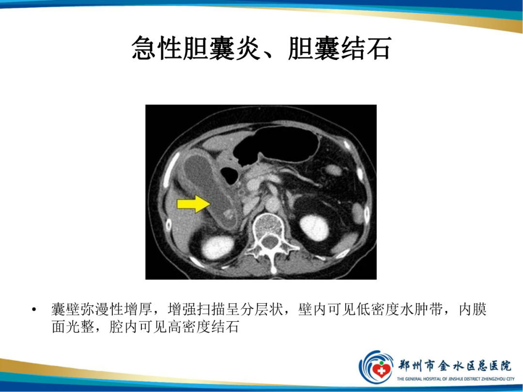 影像PPT - 【PPT】胆囊癌的影像诊断-23