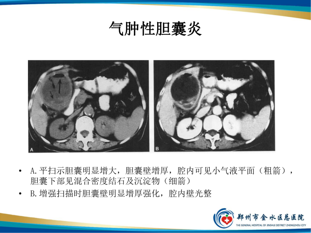 影像PPT - 【PPT】胆囊癌的影像诊断-25