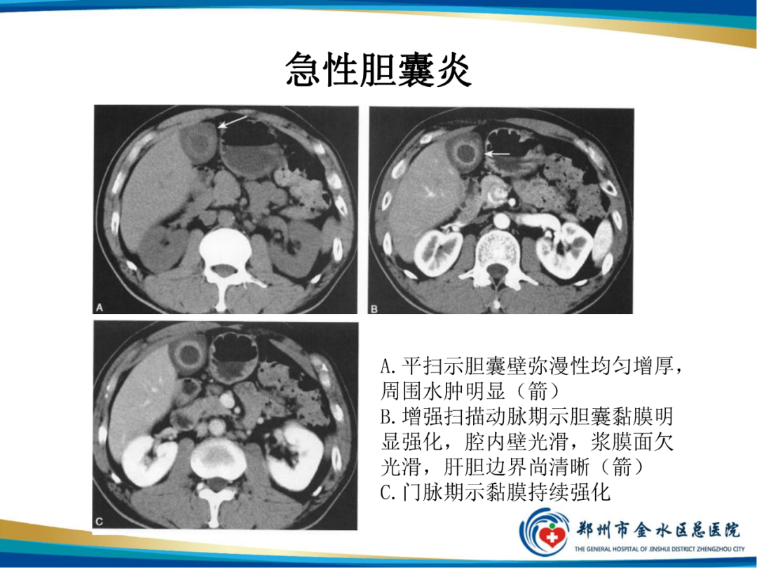 影像PPT - 【PPT】胆囊癌的影像诊断-24