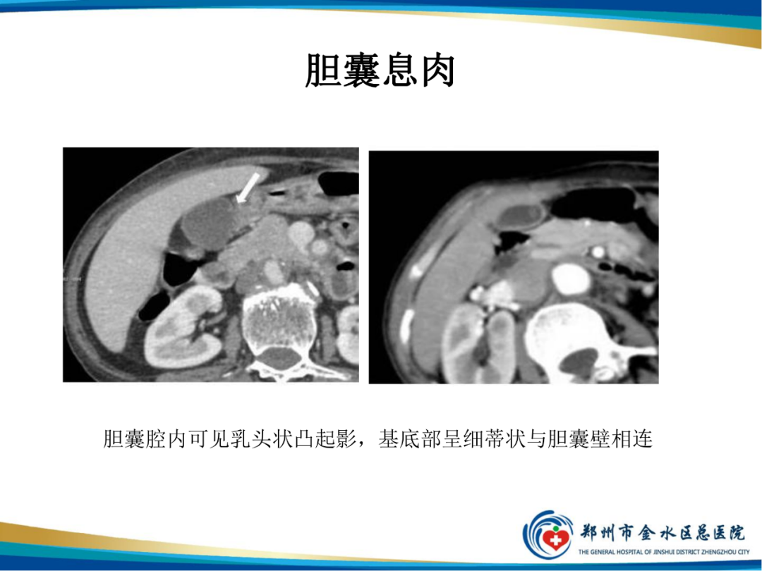 影像PPT - 【PPT】胆囊癌的影像诊断-27