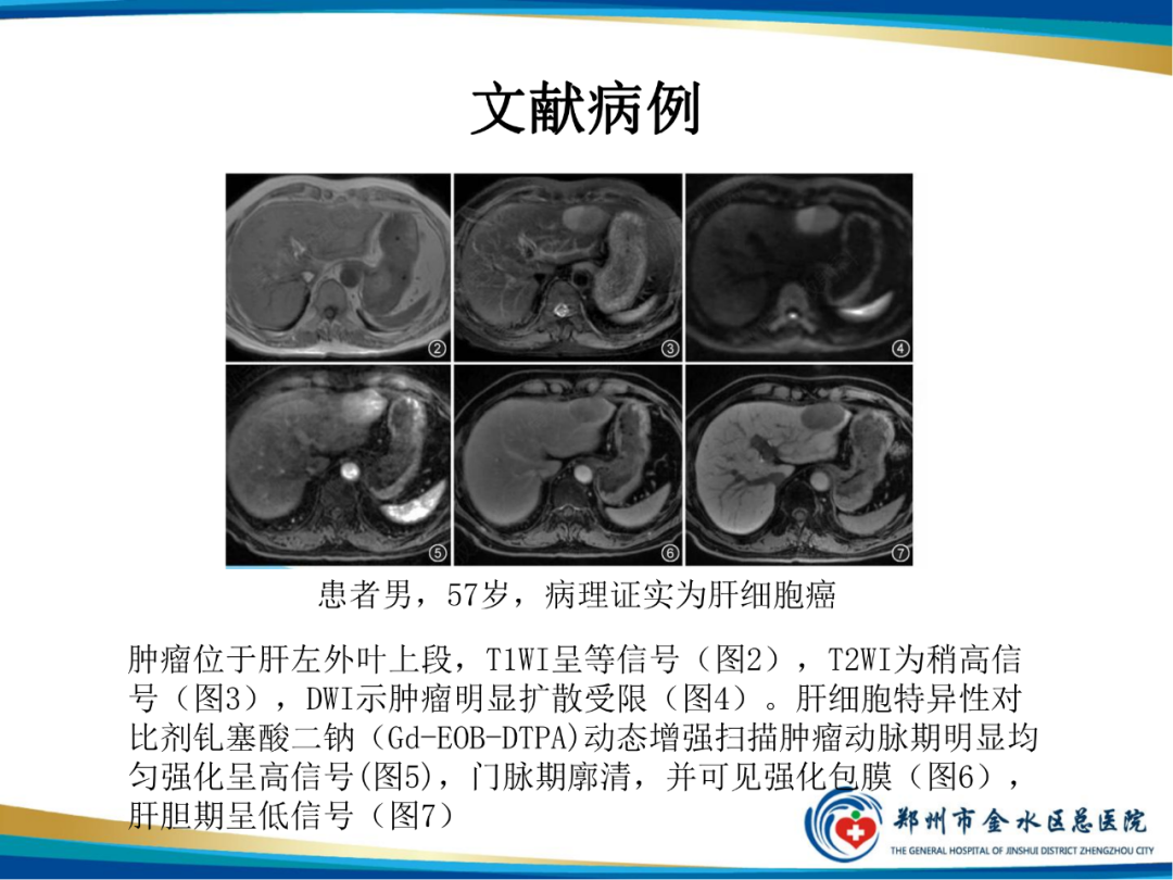 影像PPT - 【PPT】胆囊癌的影像诊断-29