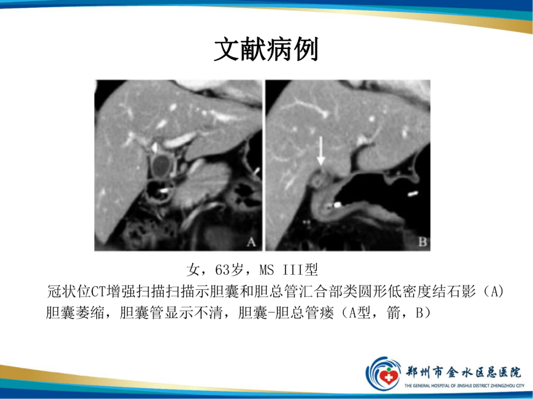 影像PPT - 【PPT】胆囊癌的影像诊断-32