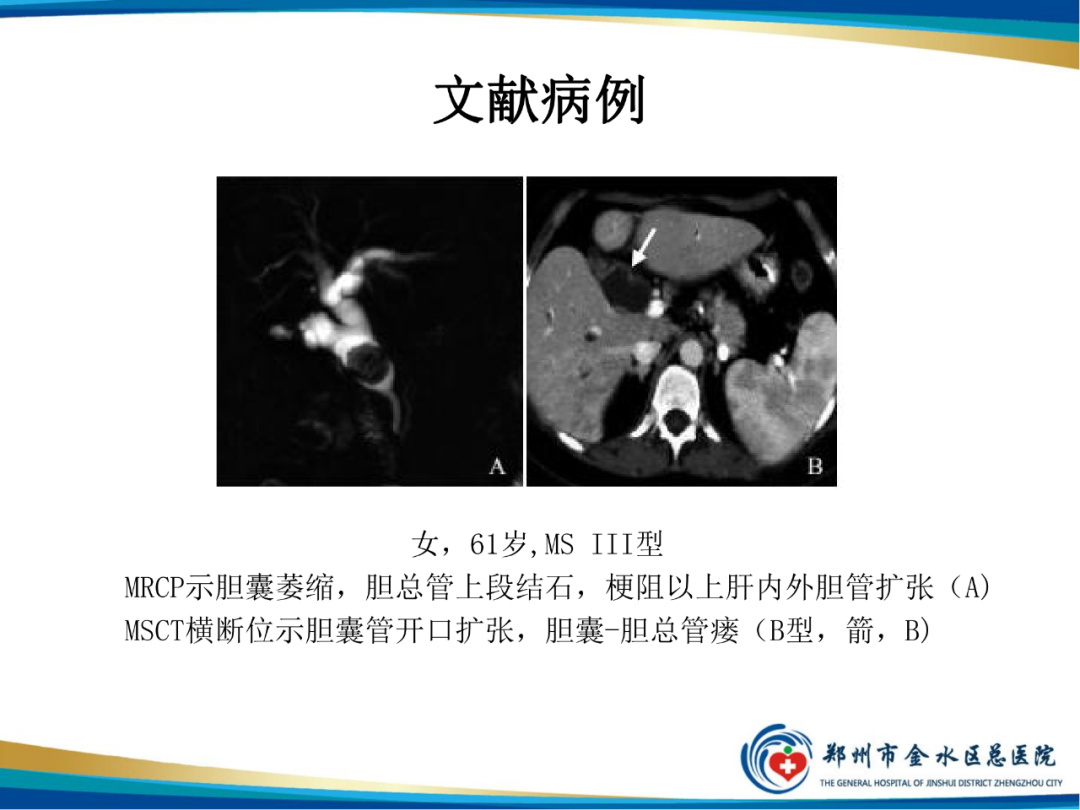 影像PPT - 【PPT】胆囊癌的影像诊断-31