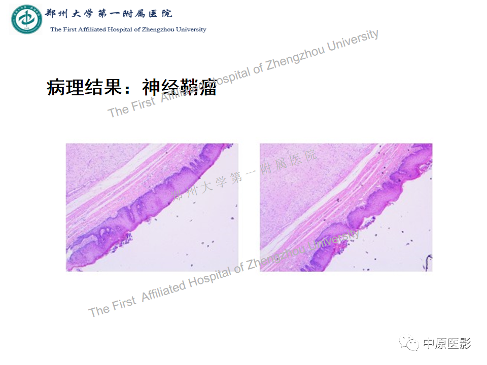 影像PPT - 【病例】舌神经鞘瘤1例MR影像-9