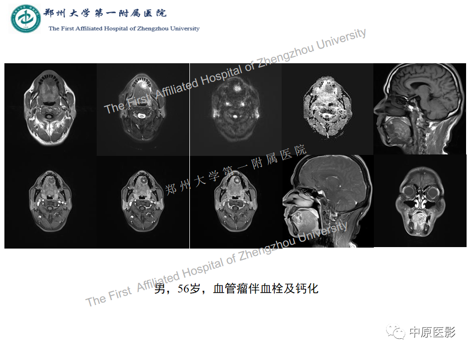 影像PPT - 【病例】舌神经鞘瘤1例MR影像-14