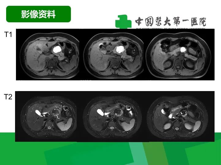 影像PPT - 【病例】胰腺实性假乳头状瘤1例CT及MR影像-4