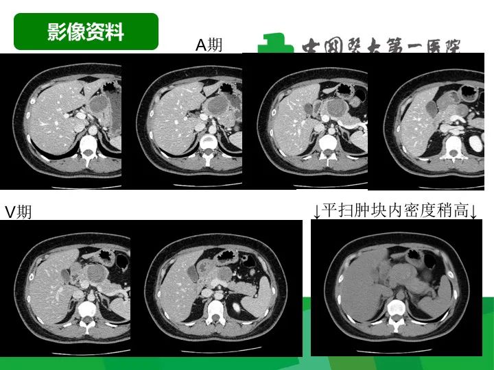 影像PPT - 【病例】胰腺实性假乳头状瘤1例CT及MR影像-3