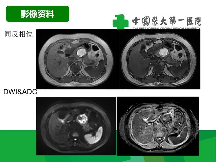 影像PPT - 【病例】胰腺实性假乳头状瘤1例CT及MR影像-5