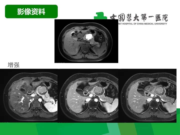 影像PPT - 【病例】胰腺实性假乳头状瘤1例CT及MR影像-6