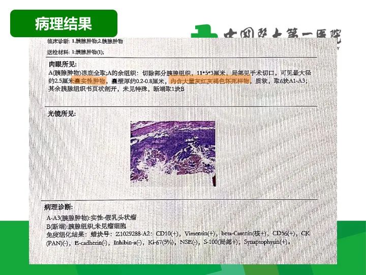 影像PPT - 【病例】胰腺实性假乳头状瘤1例CT及MR影像-9