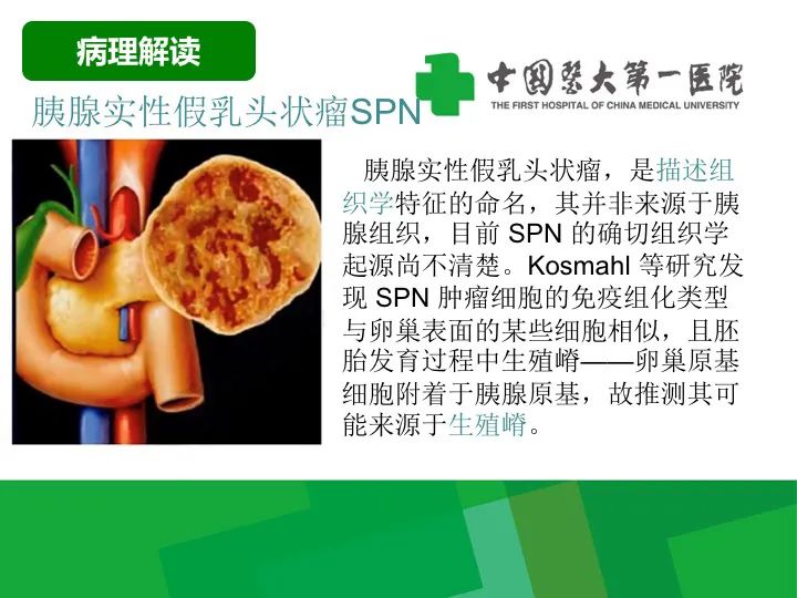 影像PPT - 【病例】胰腺实性假乳头状瘤1例CT及MR影像-11