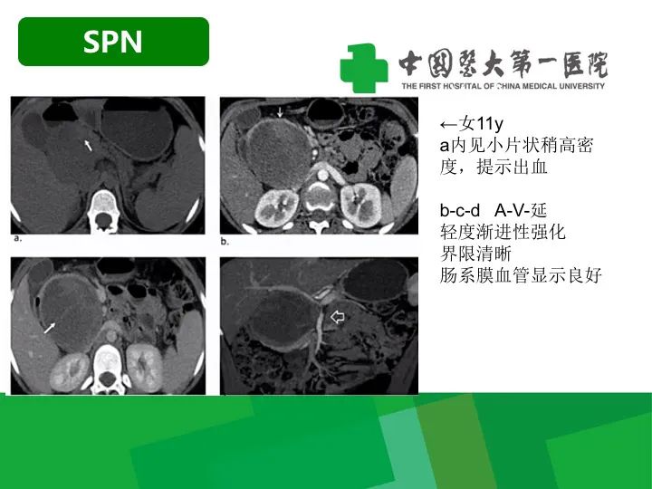 影像PPT - 【病例】胰腺实性假乳头状瘤1例CT及MR影像-14