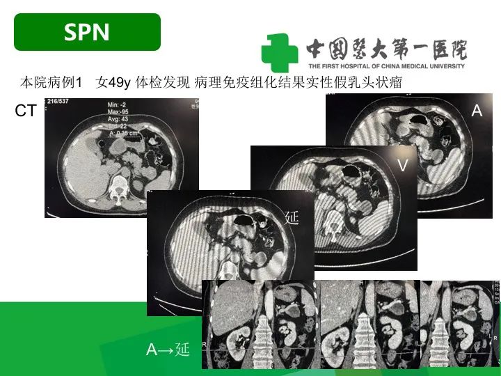 影像PPT - 【病例】胰腺实性假乳头状瘤1例CT及MR影像-15