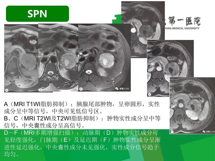 影像PPT - 【病例】胰腺实性假乳头状瘤1例CT及MR影像-17