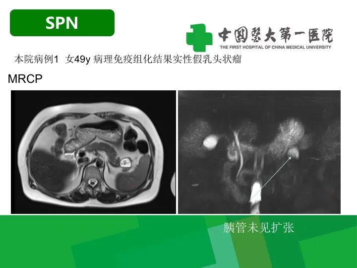 影像PPT - 【病例】胰腺实性假乳头状瘤1例CT及MR影像-16