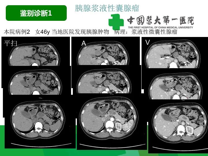 影像PPT - 【病例】胰腺实性假乳头状瘤1例CT及MR影像-24