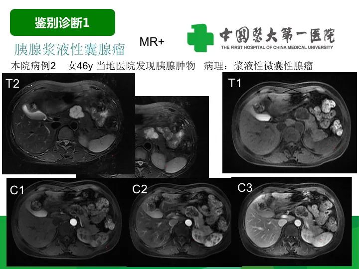 影像PPT - 【病例】胰腺实性假乳头状瘤1例CT及MR影像-25