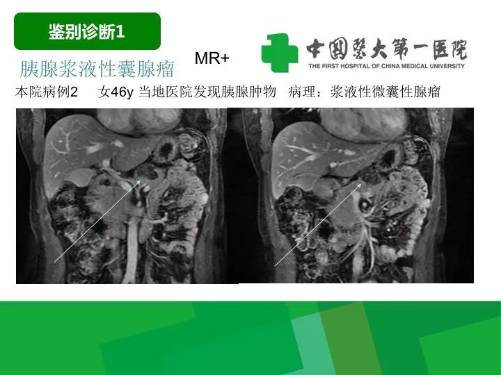 影像PPT - 【病例】胰腺实性假乳头状瘤1例CT及MR影像-26