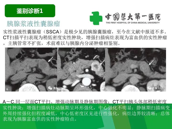影像PPT - 【病例】胰腺实性假乳头状瘤1例CT及MR影像-27