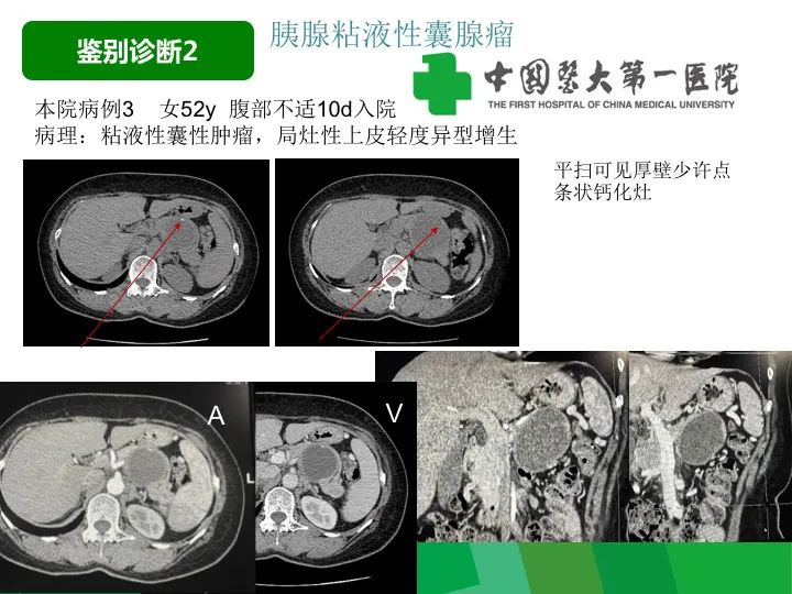 影像PPT - 【病例】胰腺实性假乳头状瘤1例CT及MR影像-30