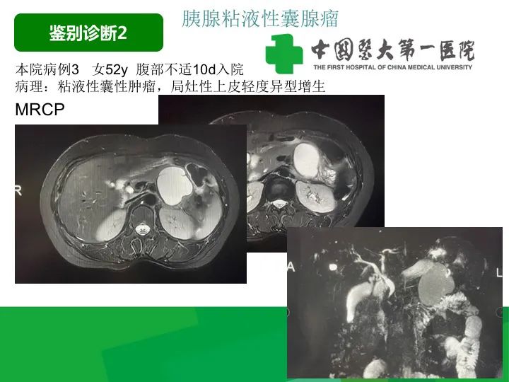 影像PPT - 【病例】胰腺实性假乳头状瘤1例CT及MR影像-31