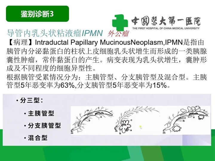影像PPT - 【病例】胰腺实性假乳头状瘤1例CT及MR影像-32