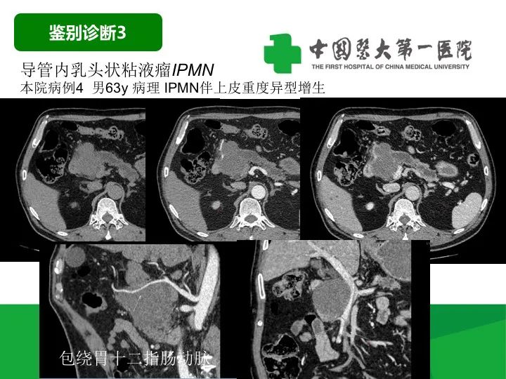 影像PPT - 【病例】胰腺实性假乳头状瘤1例CT及MR影像-35