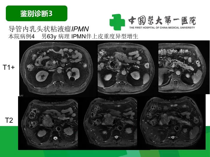 影像PPT - 【病例】胰腺实性假乳头状瘤1例CT及MR影像-36