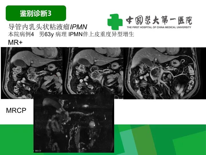 影像PPT - 【病例】胰腺实性假乳头状瘤1例CT及MR影像-37