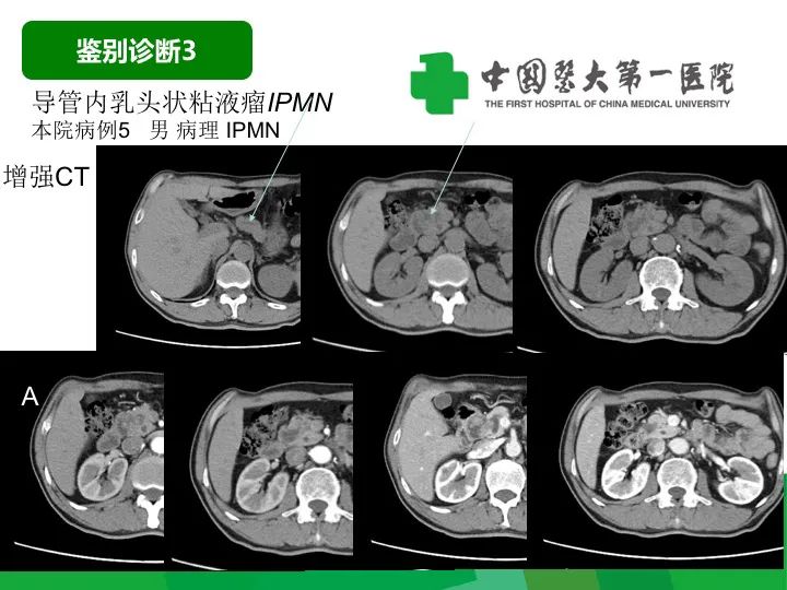 影像PPT - 【病例】胰腺实性假乳头状瘤1例CT及MR影像-38