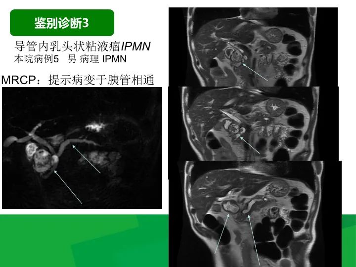 影像PPT - 【病例】胰腺实性假乳头状瘤1例CT及MR影像-39