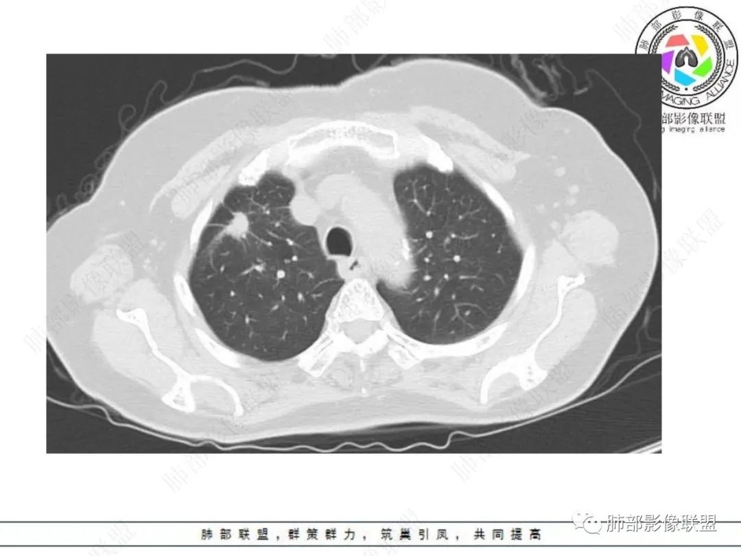 影像PPT - 【病例】孤立结节辨良恶,寻找细节定乾坤!-2 影像PPT - 【病例】孤立结节辨良恶,寻找细节定乾坤!-2