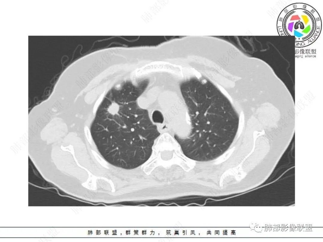 影像PPT - 【病例】孤立结节辨良恶,寻找细节定乾坤!-3 影像PPT - 【病例】孤立结节辨良恶,寻找细节定乾坤!-3