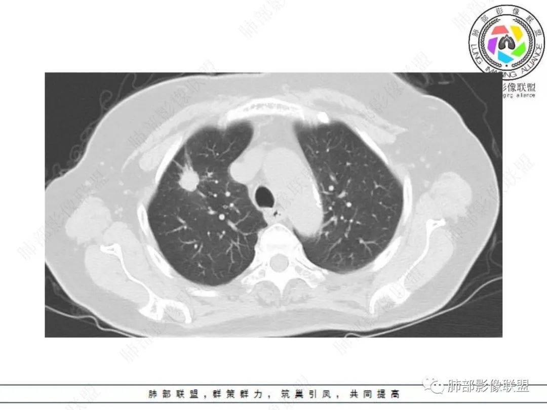 影像PPT - 【病例】孤立结节辨良恶,寻找细节定乾坤!-4 影像PPT - 【病例】孤立结节辨良恶,寻找细节定乾坤!-4