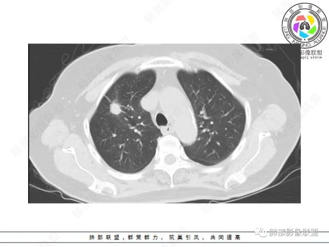 影像PPT - 【病例】孤立结节辨良恶,寻找细节定乾坤!-5 影像PPT - 【病例】孤立结节辨良恶,寻找细节定乾坤!-5